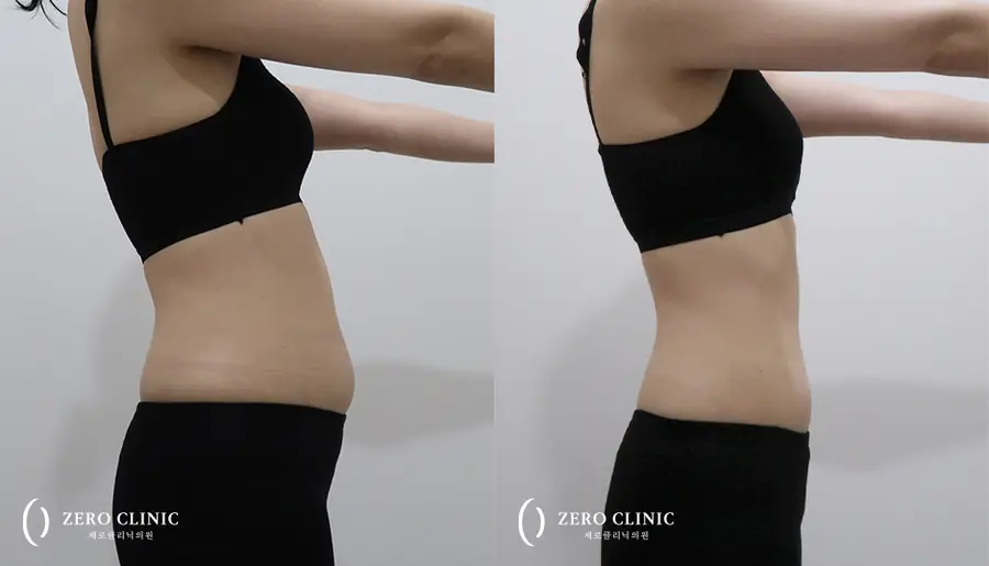 복부 지방분해주사 시술 전후 비교, 바디 제로컷 주 1회 5회, 제로클리닉 신사본점
